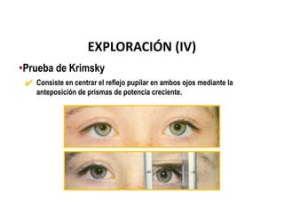 •Prueba de Krimsky
✔ Consiste en centrar el reflejo pupilar en ambos ojos mediante la
anteposición de prismas de potencia creciente.
EXPLORACIÓN (IV)
 