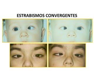 ESTRABISMOS CONVERGENTES
 