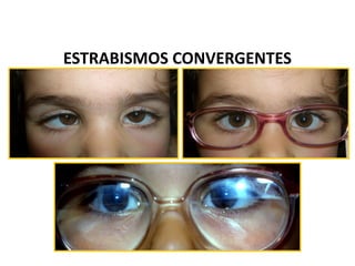 ESTRABISMOS CONVERGENTES
 