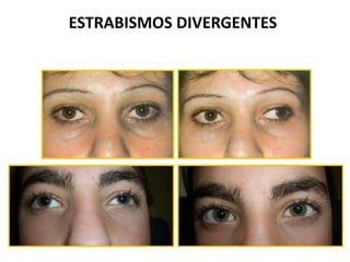 ESTRABISMOS DIVERGENTES
 