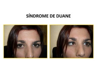 SÍNDROME DE DUANE
 