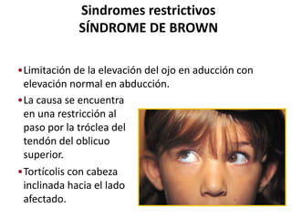 Sindromes restrictivos
SÍNDROME DE BROWN
•Limitación de la elevación del ojo en aducción con
elevación normal en abducción.
•La causa se encuentra
en una restricción al
paso por la tróclea del
tendón del oblicuo
superior.
•Tortícolis con cabeza
inclinada hacia el lado
afectado.
 