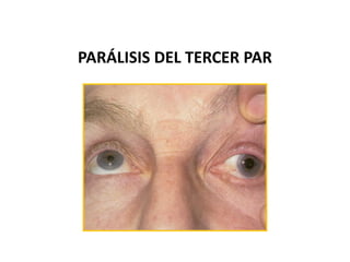 PARÁLISIS DEL TERCER PAR
 