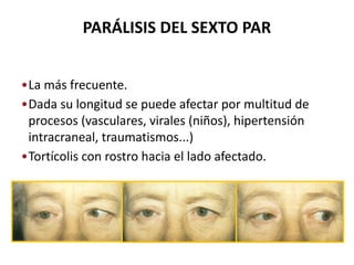 •La más frecuente.
•Dada su longitud se puede afectar por multitud de
procesos (vasculares, virales (niños), hipertensión
intracraneal, traumatismos...)
•Tortícolis con rostro hacia el lado afectado.
PARÁLISIS DEL SEXTO PAR
 