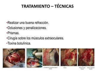 •Realizar una buena refracción.
•Oclusiones y penalizaciones.
•Prismas.
•Cirugía sobre los músculos extraoculares.
•Toxina botulínica.
TRATAMIENTO – TÉCNICAS
 