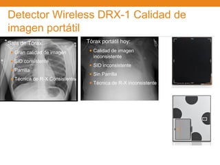 Detector Wireless DRX-1 Calidad de
imagen portátil
Sala de Tórax:                  Tórax portátil hoy:

 • Gran calidad de imagen        • Calidad de imagen
                                  inconsistente
 • SID consistente
                                 • SID inconsistente
 • Parrilla
                                 • Sin Parrilla
 • Técnica de R-X Consistente
                                 • Técnica de R-X inconsistente
 