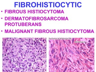 FIBROHISTIOCYTIC 
• FIBROUS HISTIOCYTOMA 
• DERMATOFIBROSARCOMA 
PROTUBERANS 
• MALIGNANT FIBROUS HISTIOCYTOMA 
 
