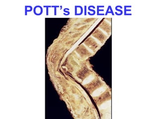 POTT’s DISEASE 
 