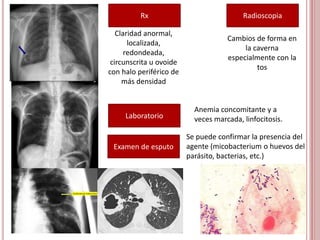 Rx
Claridad anormal,
localizada,
redondeada,
circunscrita u ovoide
con halo periférico de
más densidad
Radioscopia
Laboratorio
Cambios de forma en
la caverna
especialmente con la
tos
Anemia concomitante y a
veces marcada, linfocitosis.
Examen de esputo
Se puede confirmar la presencia del
agente (micobacterium o huevos del
parásito, bacterias, etc.)
 