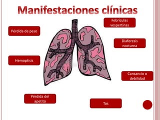 Pérdida de peso
Febrículas
vespertinas
Diaforesis
nocturna
Cansancio o
debilidad
Hemoptisis
Tos
Pérdida del
apetito
 