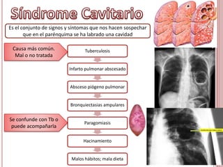 Tuberculosis
Infarto pulmonar abscesado
Absceso piógeno pulmonar
Bronquiectasias ampulares
Paragomiasis
Hacinamiento
Malos hábitos; mala dieta
Es el conjunto de signos y síntomas que nos hacen sospechar
que en el parénquima se ha labrado una cavidad
Causa más común.
Mal o no tratada
Se confunde con Tb o
puede acompañarla
 
