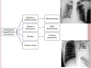 Síndrome de condensación pulmonar