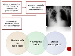 Síndrome de condensación pulmonar