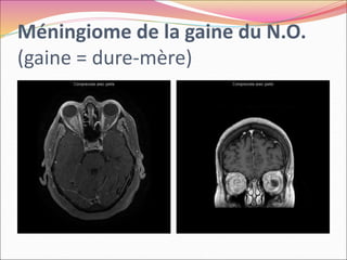 Méningiome de la gaine du N.O.
(gaine = dure-mère)
 