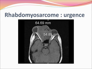 Rhabdomyosarcome : urgence
 