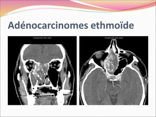Adénocarcinomes ethmoïde
 