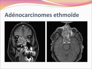 Adénocarcinomes ethmoïde
 