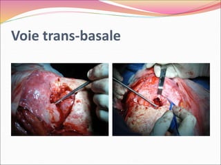 Voie trans-basale
 