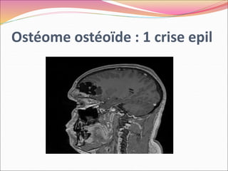 Ostéome ostéoïde : 1 crise epil
 