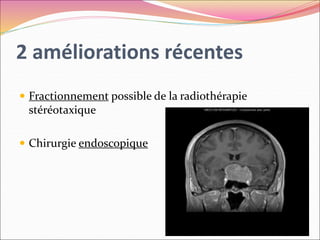 2 améliorations récentes
 Fractionnement possible de la radiothérapie
stéréotaxique
 Chirurgie endoscopique
 