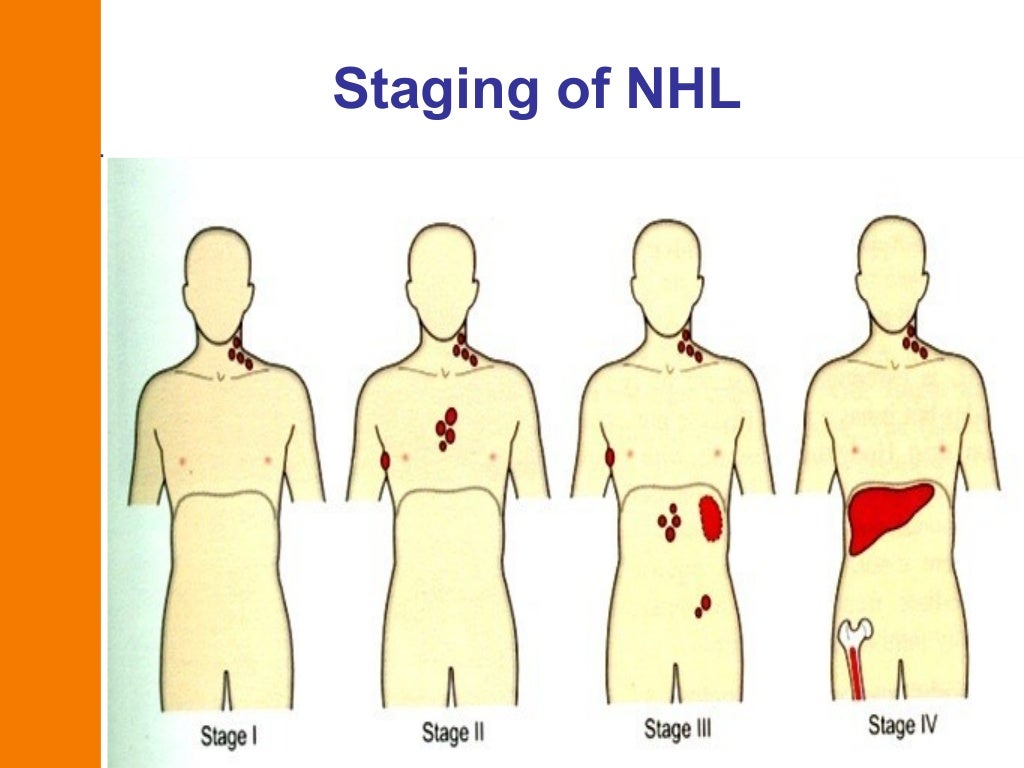 nonhodgkin’slymphoma