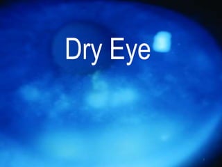 Dry Eye
1
 