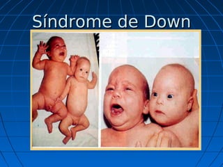 Síndrome
de
Edwards







La trisomía 18 o síndrome de Edwards
tiene una frecuencia aproximada de 1:6500
nacimientos; ...