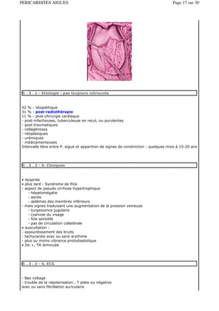PERICARDITES AIGUES                                                                  Page 17 sur 30




5 . 3 . 1 - Etiologie : pas toujours retrouvée



42 % - idiopathique
31 % - post-radiothérapie
11 % - post-chirurgie cardiaque
- post-infectieuses, tuberculeuse en recul, ou purulentes
- post-traumatiques
- collagénoses
- néoplasiques
- urémiques
- médicamenteuses
Intervalle libre entre P. aiguë et apparition de signes de constriction : quelques mois à 15-20 ans




5 . 3 . 2 - S. Cliniques



• dyspnée
• plus tard : Syndrome de Pick
- aspect de pseudo cirrhose hypertrophique
    - hépatomégalie
    - ascite
    - œdèmes des membres inférieurs
- mais signes traduisant une augmentation de la pression veineuse
    - turgescence jugulaire
    - cyanose du visage
    - foie sensible
    - pas de circulation collatérale
• auscultation :
- assourdissement des bruits
- tachycardie avec ou sans arythmie
- plus ou moins vibrance protodiastolique
• De +, TA diminuée




5 . 3 . 3 - S. ECG



- Bas voltage
- trouble de la repolarisation , T plate ou négative
avec ou sans fibrillation auriculaire
 