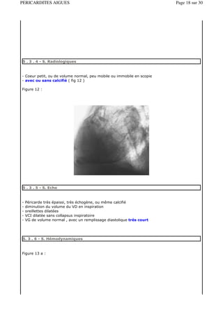 PERICARDITES AIGUES                                                    Page 18 sur 30




5 . 3 . 4 - S. Radiologiques



- Coeur petit, ou de volume normal, peu mobile ou immobile en scopie
- avec ou sans calcifié ( fig 12 )

Figure 12 :




5 . 3 . 5 - S. Echo



-   Péricarde très épaissi, très échogène, ou même calcifié
-   diminution du volume du VD en inspiration
-   oreillettes dilatées
-   VCI dilatée sans collapsus inspiratoire
-   VG de volume normal , avec un remplissage diastolique trés court




5. 3 . 6 - S. Hémodynamiques



Figure 13 a :
 