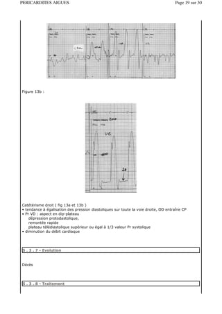 PERICARDITES AIGUES                                                                 Page 19 sur 30




Figure 13b :




Catétérisme droit ( fig 13a et 13b )
• tendance à égalisation des pression diastoliques sur toute la voie droite, OD entraîne CP
• Pr VD : aspect en dip-plateau
    dépression protodastolique,
    remontée rapide
    plateau télédiastolique supérieur ou égal à 1/3 valeur Pr systolique
• diminution du débit cardiaque




5 . 3 . 7 - Evolution



Décès




5 . 3 . 8 - Traitement
 