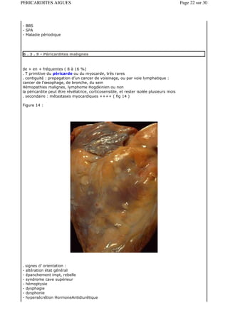 PERICARDITES AIGUES                                                                      Page 22 sur 30



- BBS
- SPA
- Maladie périodique




6 . 3 . 9 - Péricardites malignes



de + en + fréquentes ( 8 à 16 %)
. T primitive du péricarde ou du myocarde, trés rares
. contiguité : propagation d’un cancer de voisinage, ou par voie lymphatique :
cancer de l’œsophage, de bronche, du sein
Hémopathies malignes, lymphome Hogdkinien ou non
la péricardite peut être révélatrice, corticosensible, et rester isolée plusieurs mois
. secondaire : métastases myocardiques ++++ ( fig 14 )

Figure 14 :




. signes d’ orientation :
- altération état général
- épanchement impt, rebelle
- syndrome cave supérieur
- hémoptysie
- dysphagie
- dysphonie
- hypersécrétion HormoneAntidiurétique
 