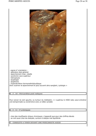 PERICARDITES AIGUES                                                                  Page 28 sur 30




. signes d’ orientation :
- altération état général
- épanchement impt, rebelle
- syndrome cave supérieur
- hémoptysie
- dysphagie
- dysphonie
- hypersécrétion HormoneAntidiurétique
Donc scanner et épanchement le plus souvent séro-sanglant, cytologie +




6 . 3 . 10 - Péricardites post radiques



Pour cancer du sein gauche, ou tumeur du médiastin; ++ supérieur à 4000 rads; peut entraîner
une tamponnade ou constrictive avec un délai variable




6 . 3 . 11 - P urémiques



- chez des insuffisants rénaux chroniques; n’apparaît que pour des chiffres élevés
- se voit aussi chez les dialysés, surtout si dialyse mal équilibrée

7 - CONDUITE A TENIR DEVANT UNE PERICARDITE AIGUE
 
