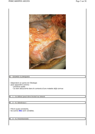 PERICARDITES AIGUES                                                   Page 3 sur 30




2 - SIGNES CLINIQUES



- Dépendent en partie de l’étiologie
- peut apparaître comme :
    - primitive isolée
    - ou bien découverte dans le contexte d’une maladie déjà connue




2 . 1 - le début peut être brutal ou latent


2 . 2 - S. Généraux :



- Fièvre quasi constante,
- les autres SGx sont variables.




2 . 3 - S. Fonctionnels
 
