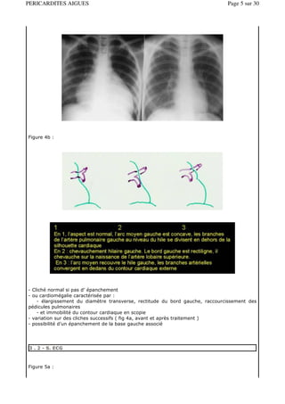 PERICARDITES AIGUES                                                           Page 5 sur 30




Figure 4b :




- Cliché normal si pas d’ épanchement
- ou cardiomégalie caractérisée par :
    - élargissement du diamètre transverse, rectitude du bord gauche, raccourcissement des
pédicules pulmonaires
    - et immobilité du contour cardiaque en scopie
- variation sur des cliches successifs ( fig 4a, avant et après traitement )
- possibilité d’un épanchement de la base gauche associé




3 . 2 - S. ECG



Figure 5a :
 