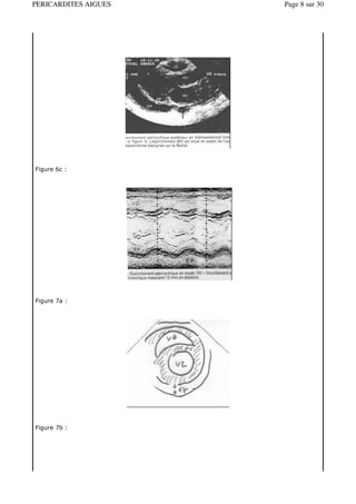 PERICARDITES AIGUES   Page 8 sur 30




Figure 6c :




Figure 7a :




Figure 7b :
 