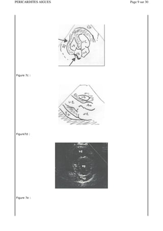 PERICARDITES AIGUES   Page 9 sur 30




Figure 7c :




Figure7d :




Figure 7e :
 
