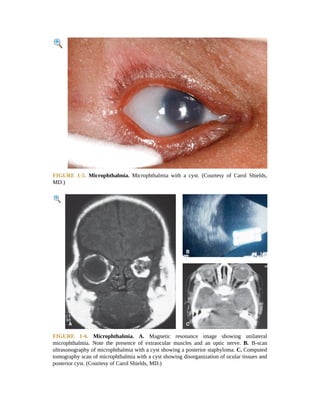 Microphthalmic Pediatric Ophthalmology Color Atlas And Synopsis Of Clinical ...
