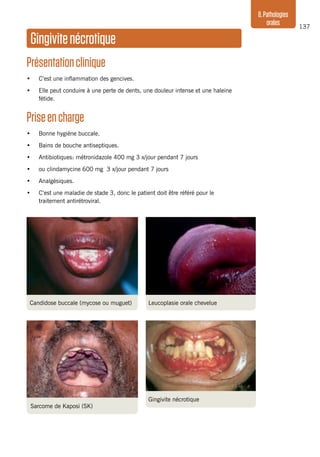137
8.Pathologies
orales
Gingivitenécrotique
Présentationclinique
•	 C’est une inflammation des gencives.
•	 Elle peut conduire à une perte de dents, une douleur intense et une haleine
fétide.
Priseencharge
•	 Bonne hygiène buccale.
•	 Bains de bouche antiseptiques.
•	 Antibiotiques: métronidazole 400 mg 3 x/jour pendant 7 jours
•	 ou clindamycine 600 mg 3 x/jour pendant 7 jours
•	 Analgésiques.
•	 C’est une maladie de stade 3, donc le patient doit être référé pour le
traitement antirétroviral.
Candidose buccale (mycose ou muguet)
Sarcome de Kaposi (SK)
Gingivite nécrotique
Leucoplasie orale chevelue
 