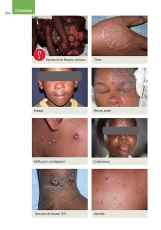 164
9.Dermatologie
Herpes
Tinea
Herpes zoster
Molluscum contagiosum Cryptocoque
Sarcome de Kaposi (SK) Varicelle
Syndrome de Stevens-Johnson
 