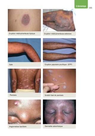 165
9.Dermatologie
Psoriasis Scratch test de psoriasis
Eruption médicamenteuse extensiveEruption médicamenteuse topique
Gale Eruption papulaire pruritique (EPP)
Angiomatose bacillaire Dermatite seborrheique
 