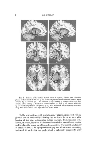 6 J.D. MURRAY
FIG. 1. Sections of the virtual human brain in sagittal, coronal and horizontal
planes that intersect at the site of the glioma originating in the superior frontal region
denoted by an asterisk (*). Red denotes a high density of tumour cells while blue
denotes a low density. A thick black contour defines the edge of the tumour detectable
by enhanced computerized tomography (CT). Cell migration was allowed to occur in a
truly three-dimensional solid representation of the brain.
Unlike real patients with real gliomas, virtual patients with virtual
gliomas can be analyzed by allowing any particular factor to vary while
keeping all the other determining factors constant. Such isolation tech-
niques, of course, require a mathematical model that has sufficient realism
and involves the major variables and parameters. The recent availability
of simulated MRl's, with proportions of grey and white matter accurately
indicated, let us develop this model which is sufficiently complex to allow
 