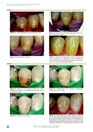 27 articulo biseles en-preparaciones-dentarias anteriores 2006 | PDF