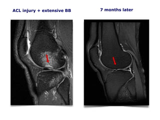 ACL injury + extensive BB
CKC MRI 110206
7 months later
 