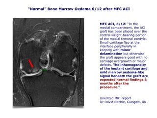 MFC ACI, 6/12: “In the
medial compartment, the ACI
graft has been placed over the
central weight-bearing portion
of the medial femoral condyle.
Small cartilage flap at the
interface peripherally in
keeping with minor
delamination but otherwise
the graft appears good with no
cartilage overgrowth or major
defects. The inhomogeneity
of the implant cartilage and
mild marrow oedema-like
signal beneath the graft are
expected normal findings 6
months after the
procedure.”
Unedited MRI report
Dr David Ritchie, Glasgow, UKCKC MRI 260906
“Normal” Bone Marrow Oedema 6/12 after MFC ACI
 