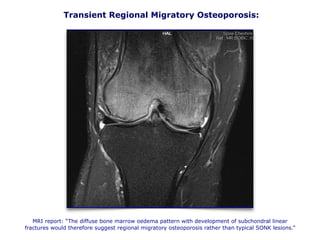 Transient Regional Migratory Osteoporosis:
MRI report: “The diffuse bone marrow oedema pattern with development of subchondral linear
fractures would therefore suggest regional migratory osteoporosis rather than typical SONK lesions.”
 