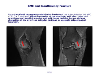 BME and Insufficiency Fracture
Recent localised incomplete subarticular fracture of the outer aspect of the MFC
(15 x 5 x 3 mm) with slight depression of the overlying articular cortex and
prominent surrounding marrow and soft tissue oedema but no obvious
disruption of the overlying articular cartilage or unstable osteochondral
fragment.
CKC UK
 