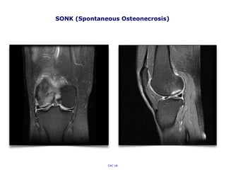 SONK (Spontaneous Osteonecrosis)
CKC UK
 