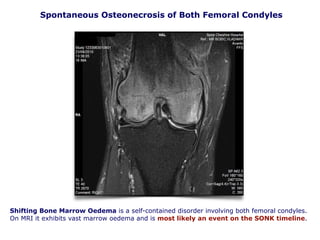Spontaneous Osteonecrosis of Both Femoral Condyles
Shifting Bone Marrow Oedema is a self-contained disorder involving both femoral condyles.
On MRI it exhibits vast marrow oedema and is most likely an event on the SONK timeline.
 