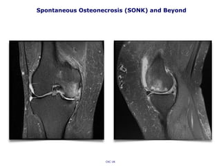 Spontaneous Osteonecrosis (SONK) and Beyond
CKC UK
 