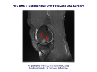 MFC BME + Subchondral Cyst Following ACL Surgery
No problems with ACL reconstruction, good
functional result, no meniscal deficiency.
 